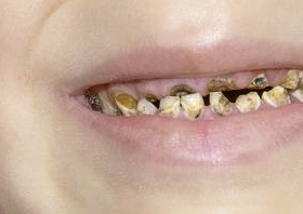 Cara Merawat Gigi Anak yang Terlanjur Gigis