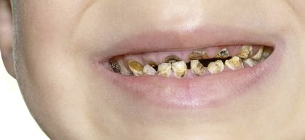 Cara Merawat Gigi Anak yang Terlanjur Gigis