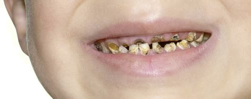 Cara Merawat Gigi Anak yang Terlanjur Gigis